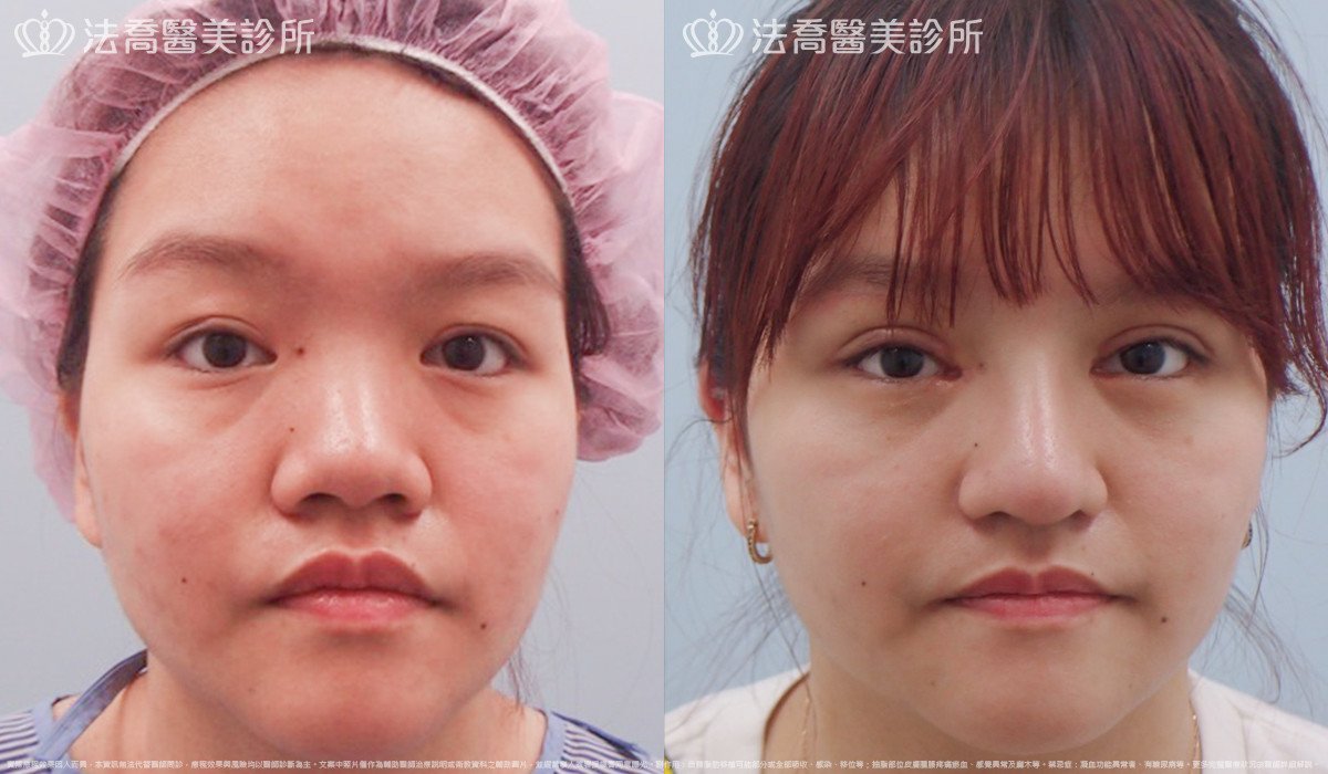 法喬醫美診所,邱浚彥,自體肋骨隆鼻