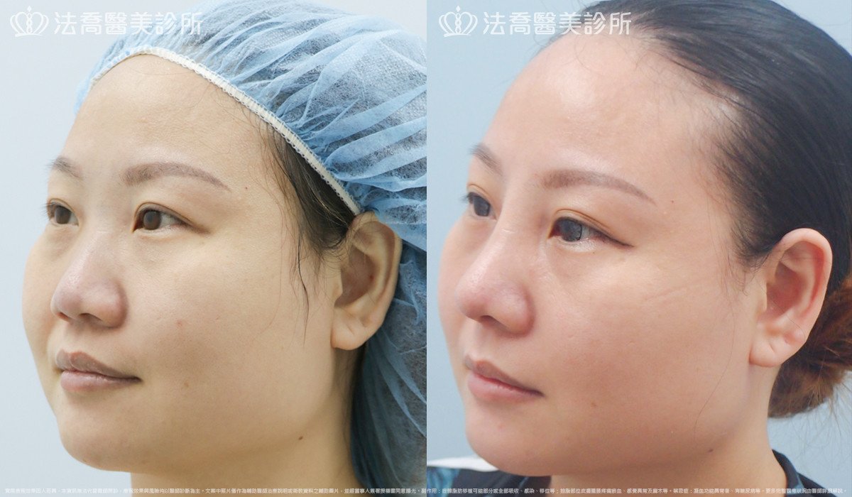 法喬醫美診所,邱浚彥,自體肋骨隆鼻