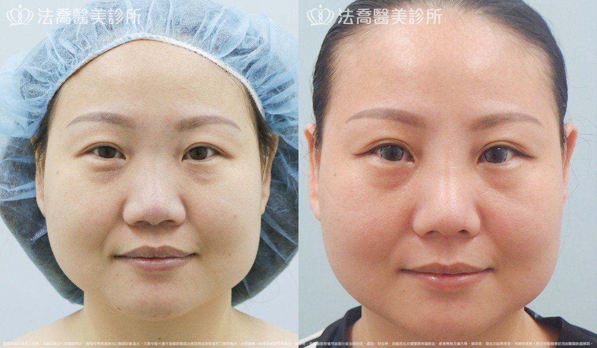 法喬醫美診所,邱浚彥,自體肋骨隆鼻