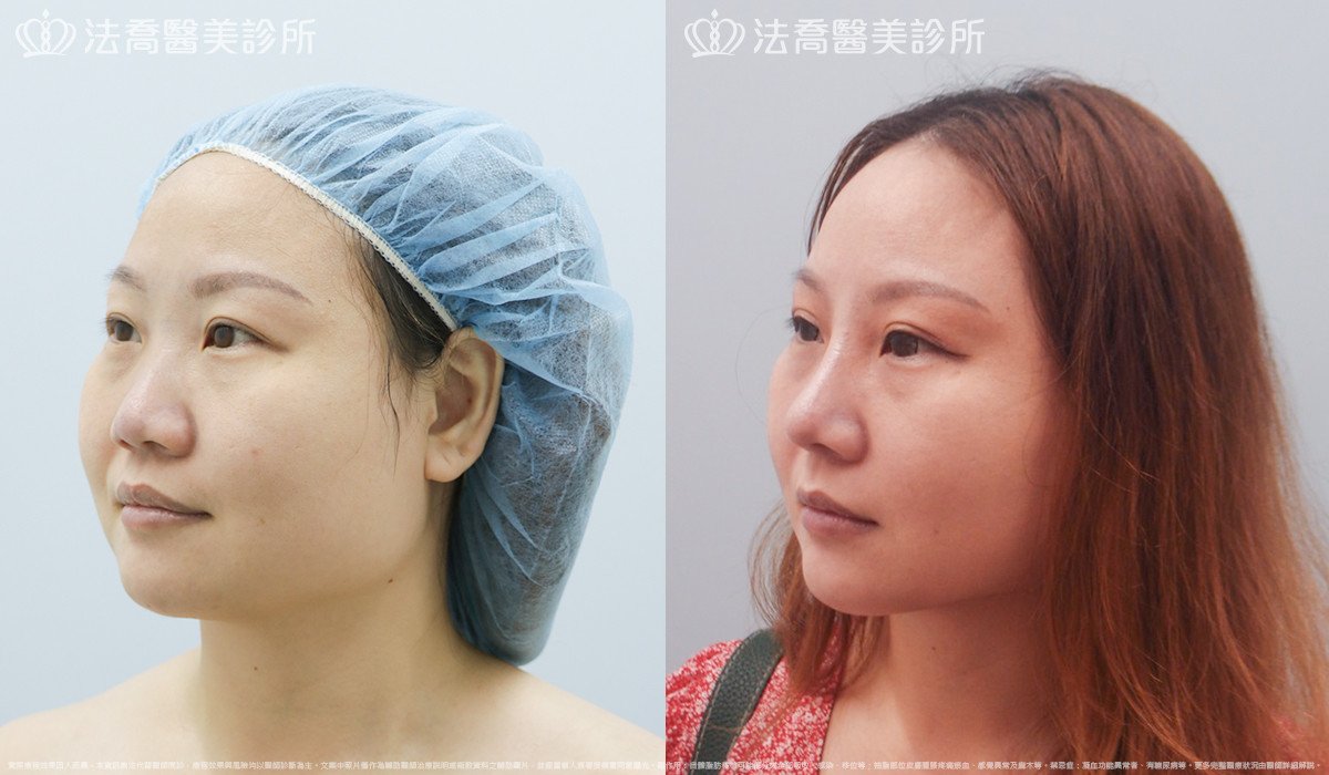 法喬醫美診所,邱浚彥,自體肋骨隆鼻