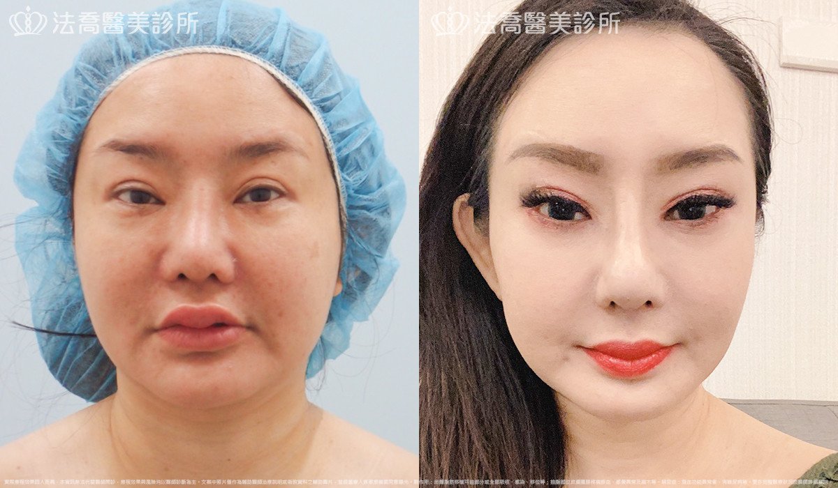 法喬醫美診所,邱浚彥,自體肋骨隆鼻