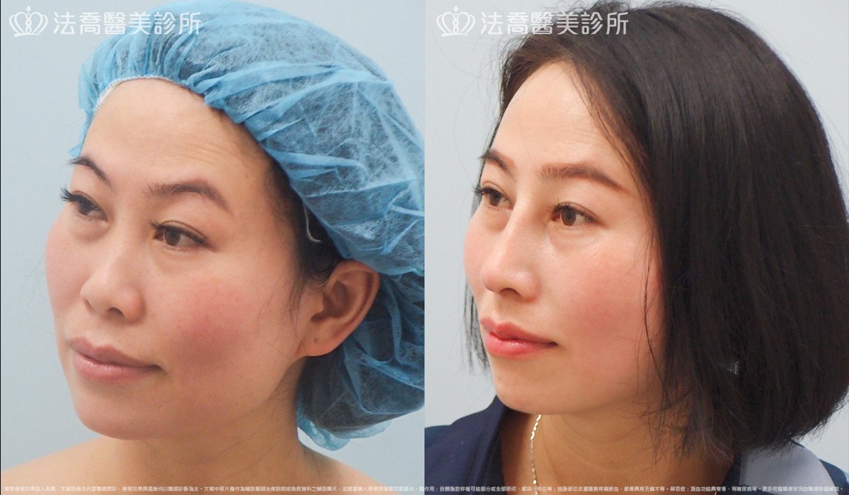 法喬醫美診所,邱浚彥,自體肋骨隆鼻