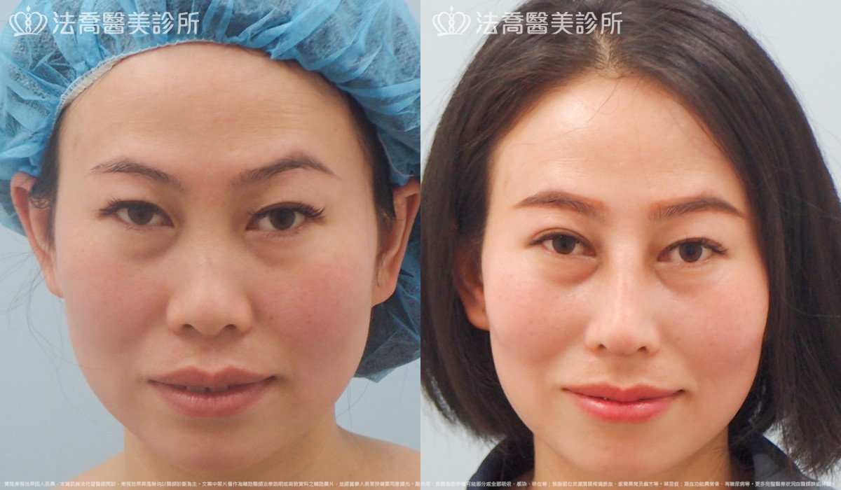 法喬醫美診所,邱浚彥,自體肋骨隆鼻