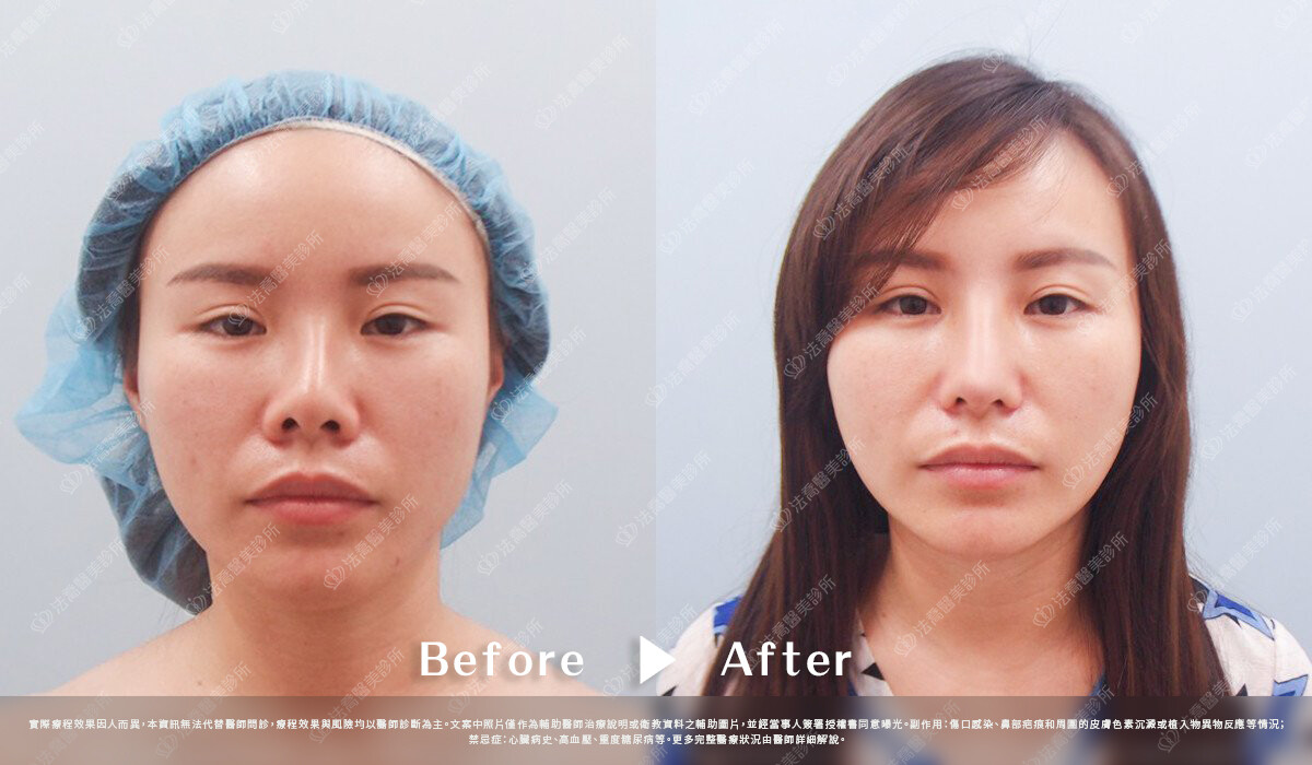 法喬醫美診所,邱浚彥,自體肋骨隆鼻