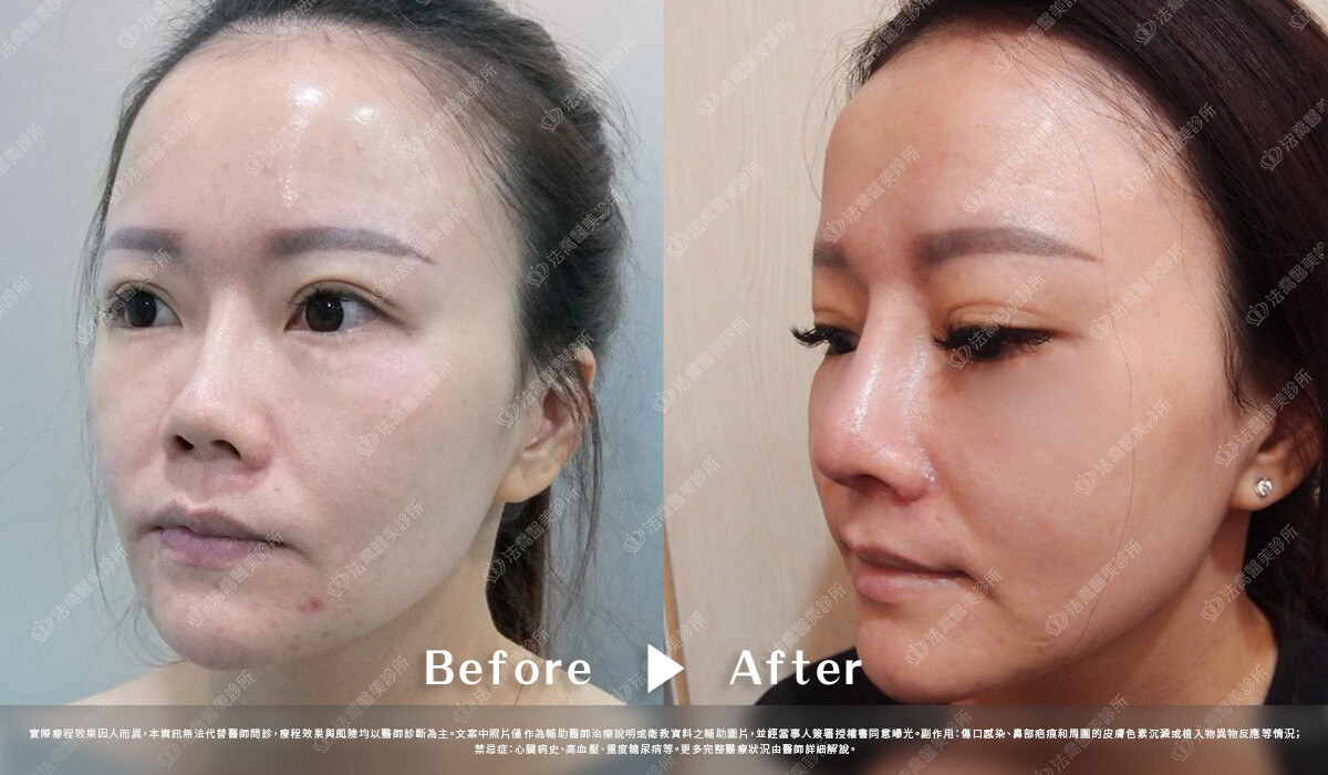 法喬醫美診所,邱浚彥,自體肋骨隆鼻