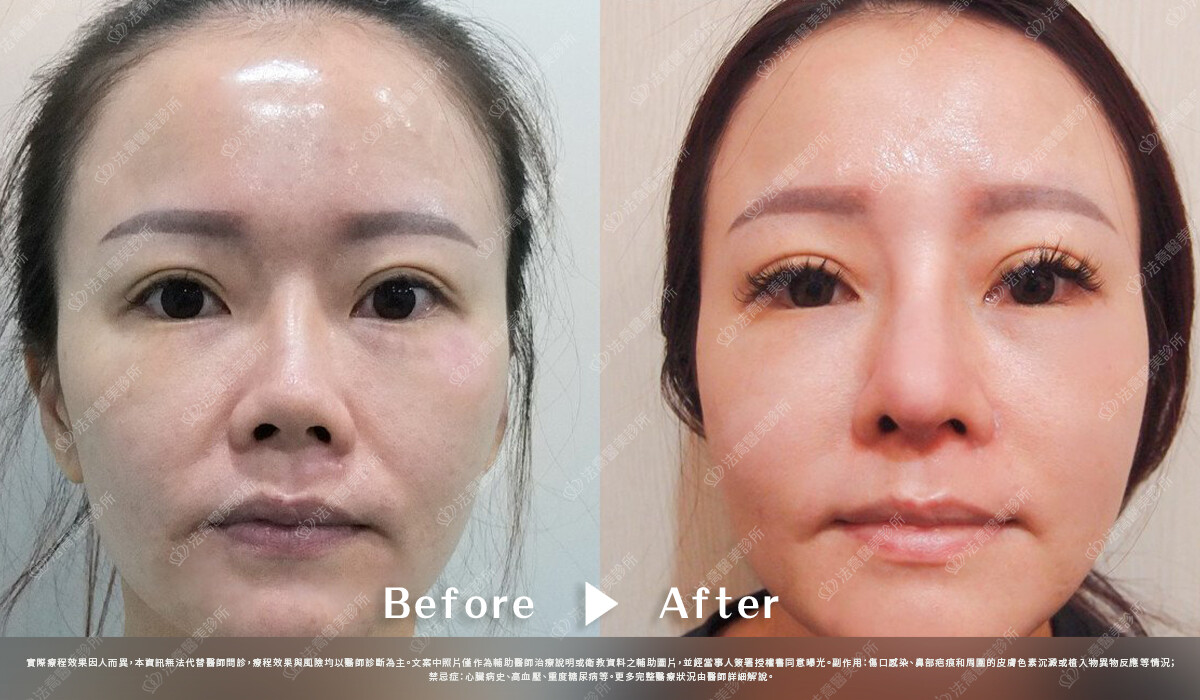 法喬醫美診所,邱浚彥,自體肋骨隆鼻