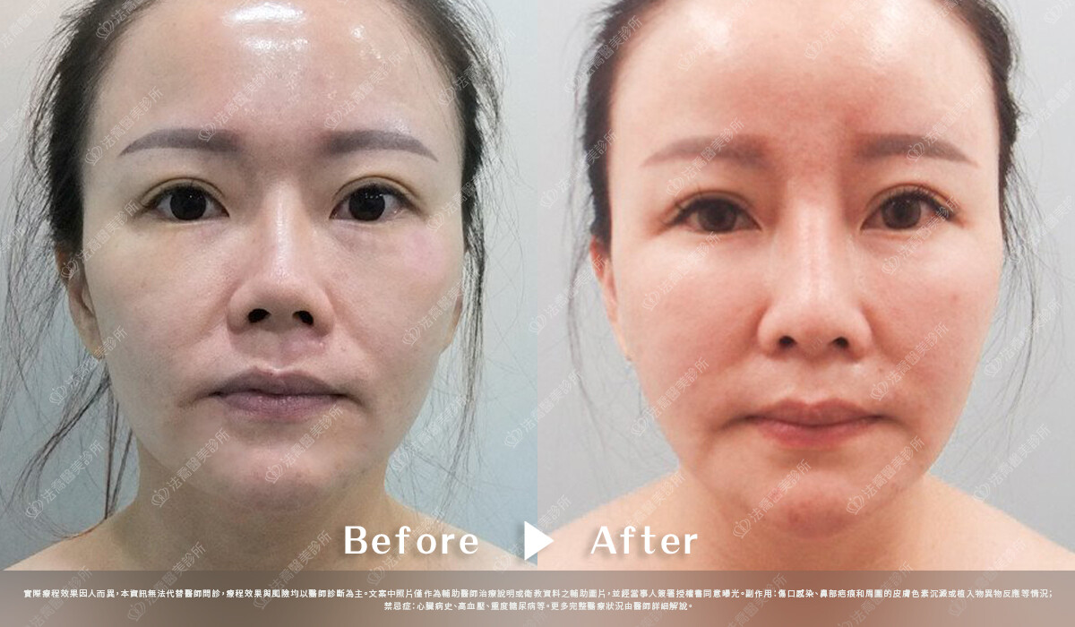 法喬醫美診所,邱浚彥,自體肋骨隆鼻