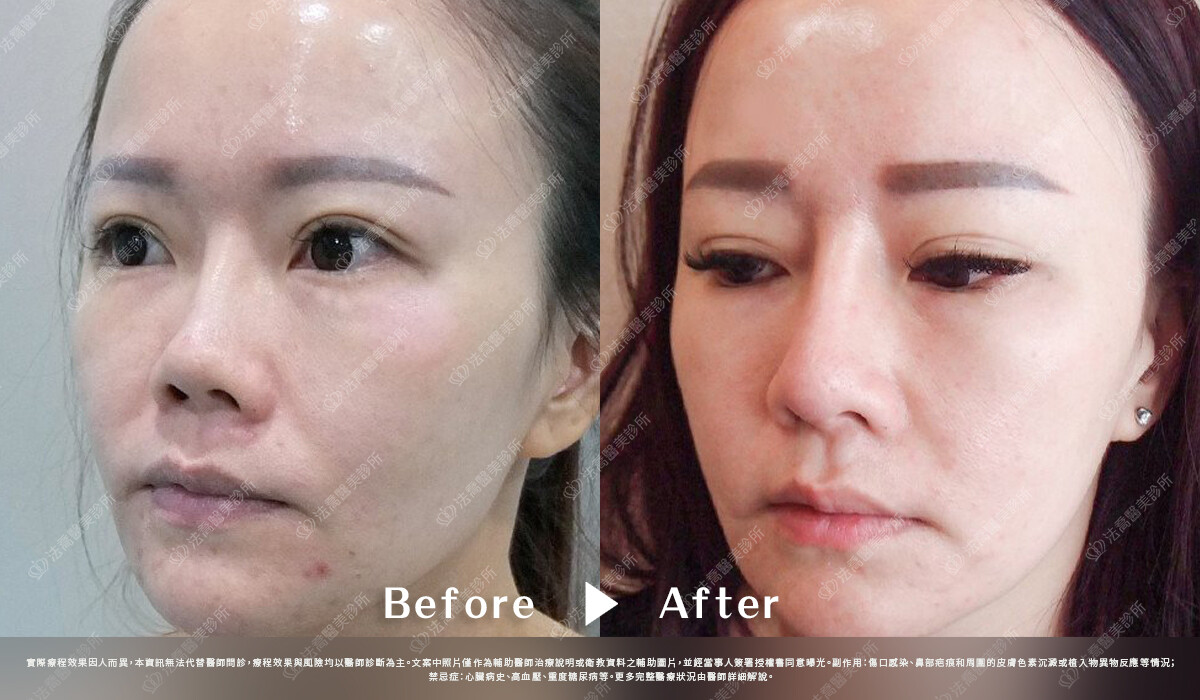 法喬醫美診所,邱浚彥,自體肋骨隆鼻