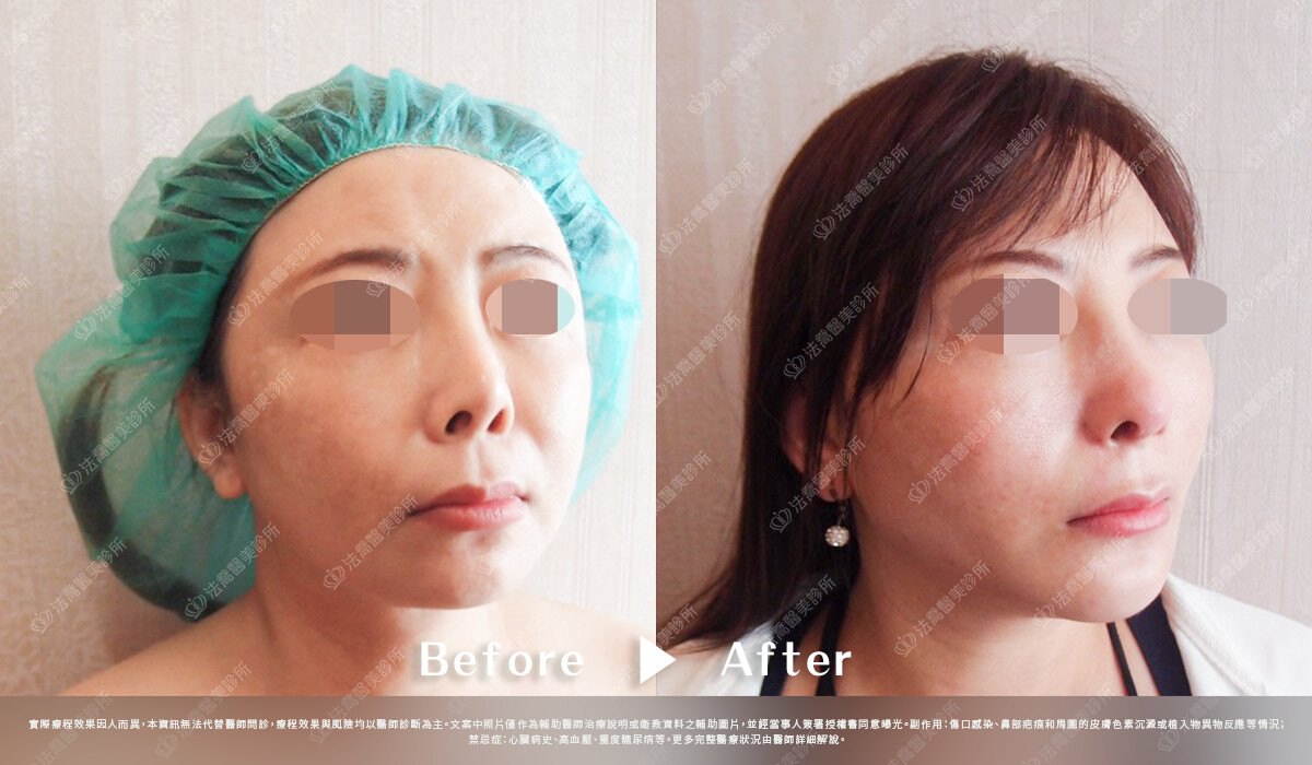 法喬醫美診所,邱浚彥,自體肋骨隆鼻