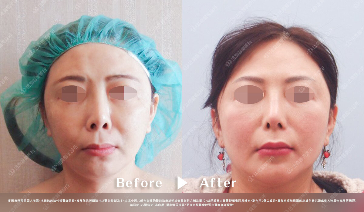 法喬醫美診所,邱浚彥,自體肋骨隆鼻