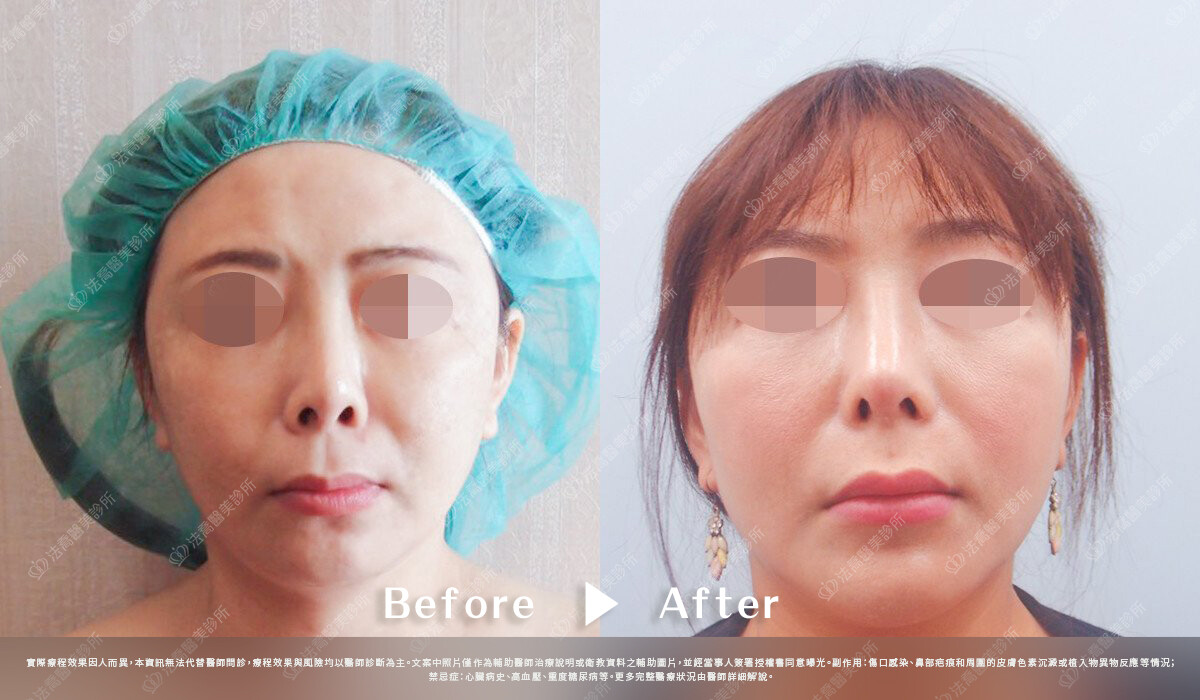 法喬醫美診所,邱浚彥,自體肋骨隆鼻