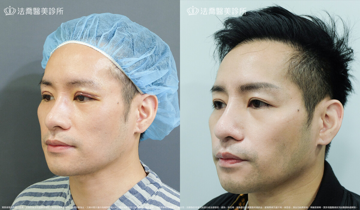 自體肋骨隆鼻,法喬醫美診所,邱浚彥
