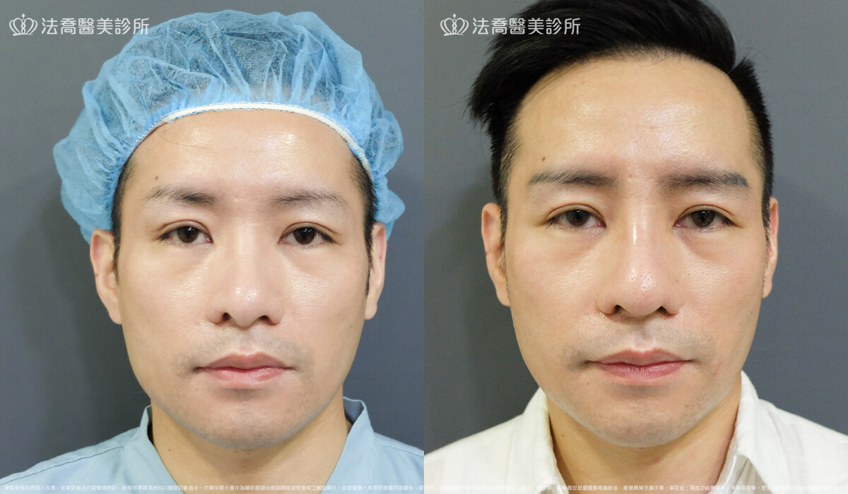 自體肋骨隆鼻,法喬醫美診所,邱浚彥