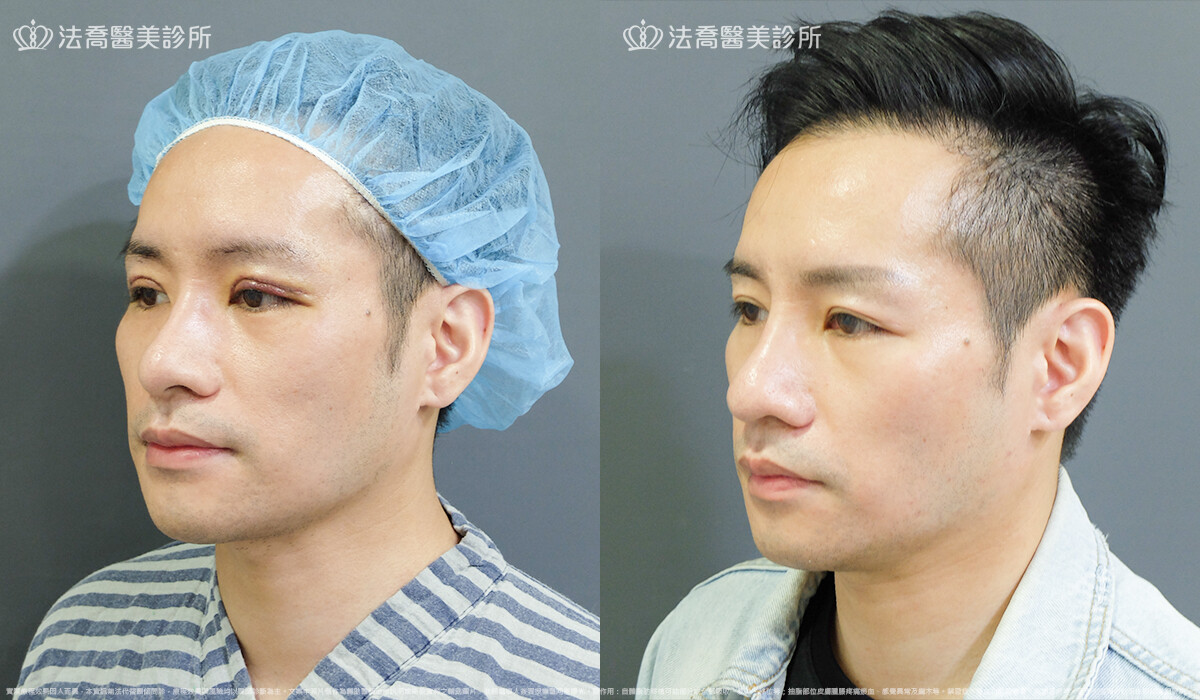 自體肋骨隆鼻,法喬醫美診所,邱浚彥