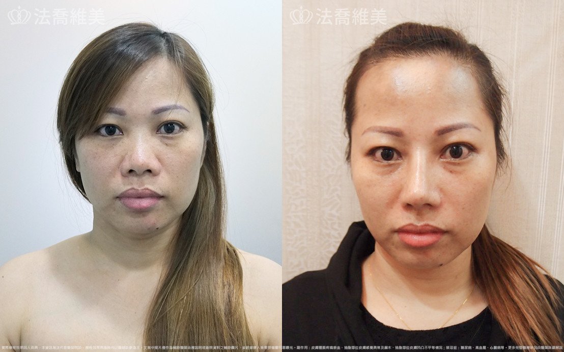 法喬醫美診所,邱浚彥,自體肋骨隆鼻