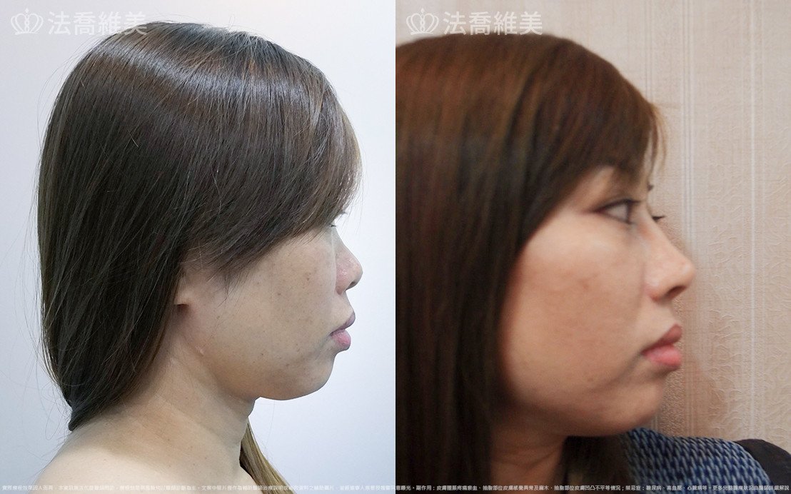 法喬醫美診所,邱浚彥,自體肋骨隆鼻
