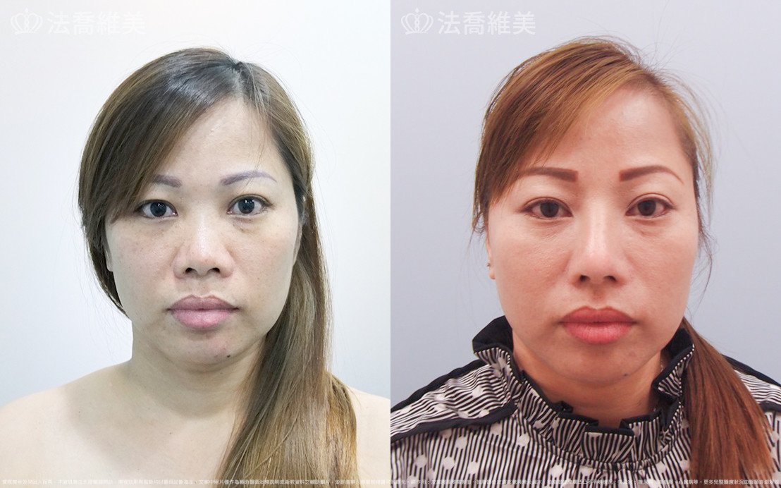 法喬醫美診所,邱浚彥,自體肋骨隆鼻