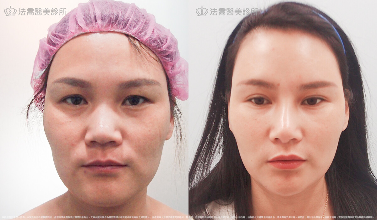 自體肋骨隆鼻,法喬醫美診所,邱浚彥