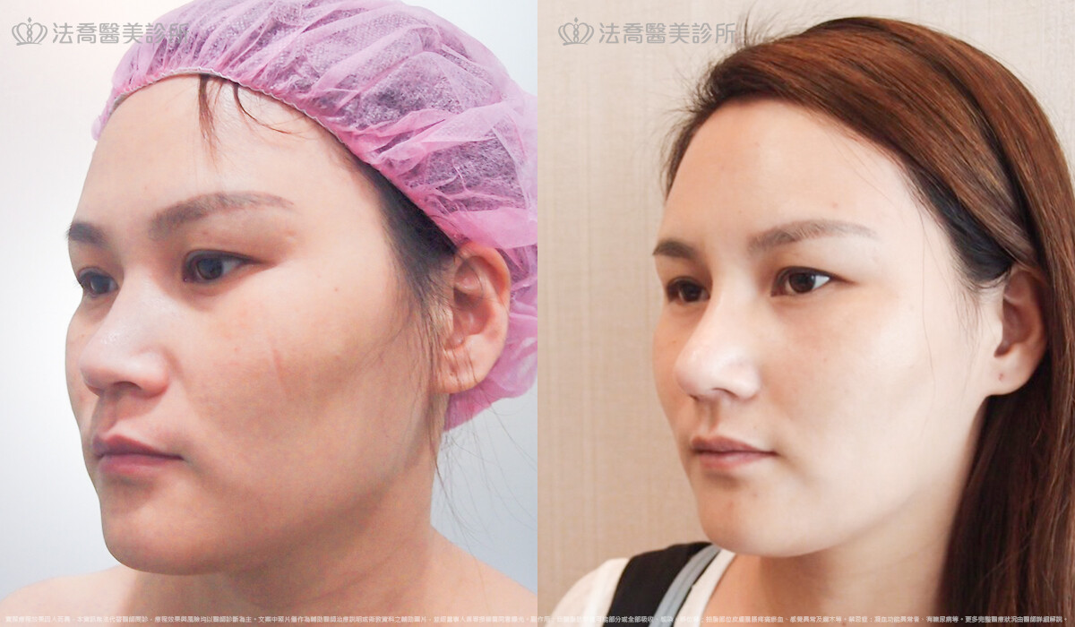 自體肋骨隆鼻,法喬醫美診所,邱浚彥