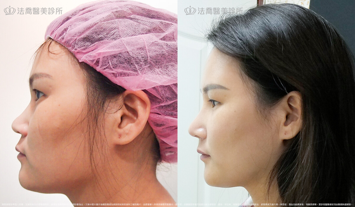 自體肋骨隆鼻,法喬醫美診所,邱浚彥