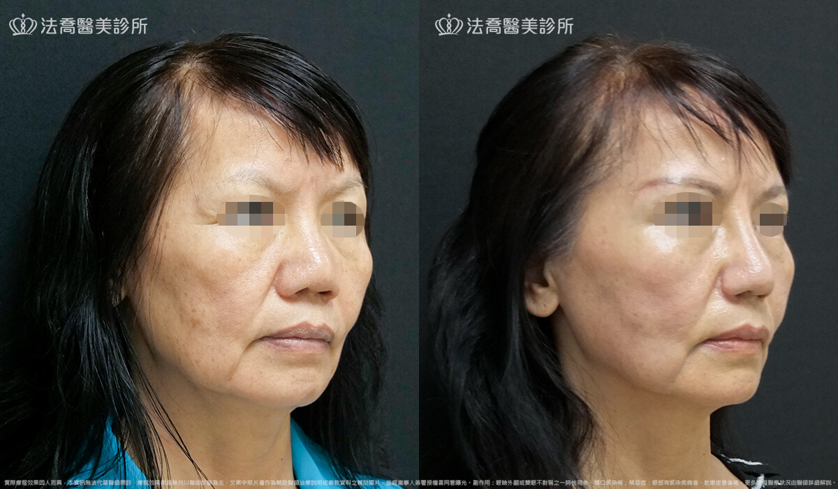 自體肋骨隆鼻,法喬醫美診所,邱浚彥