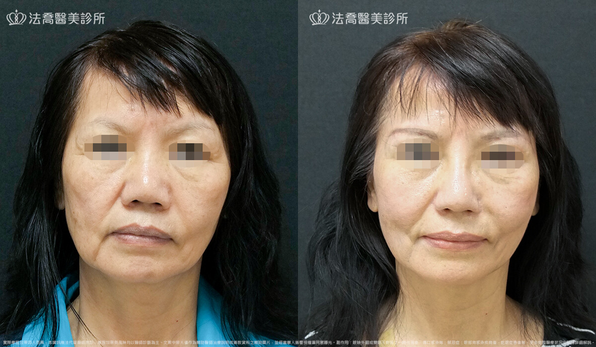 法喬醫美診所,邱浚彥,自體肋骨隆鼻,隆鼻推薦