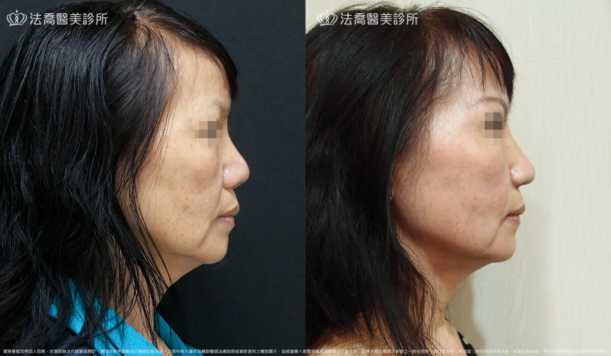 自體肋骨隆鼻,法喬醫美診所,邱浚彥