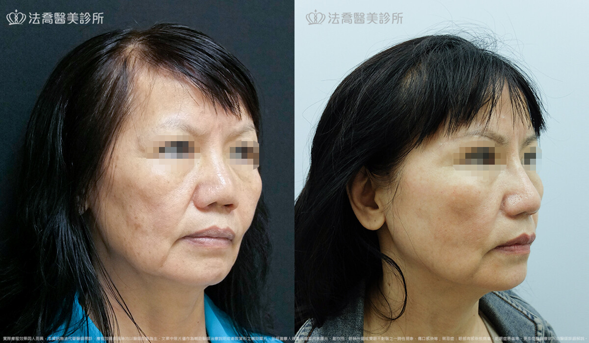 法喬醫美診所,邱浚彥,自體肋骨隆鼻,隆鼻推薦