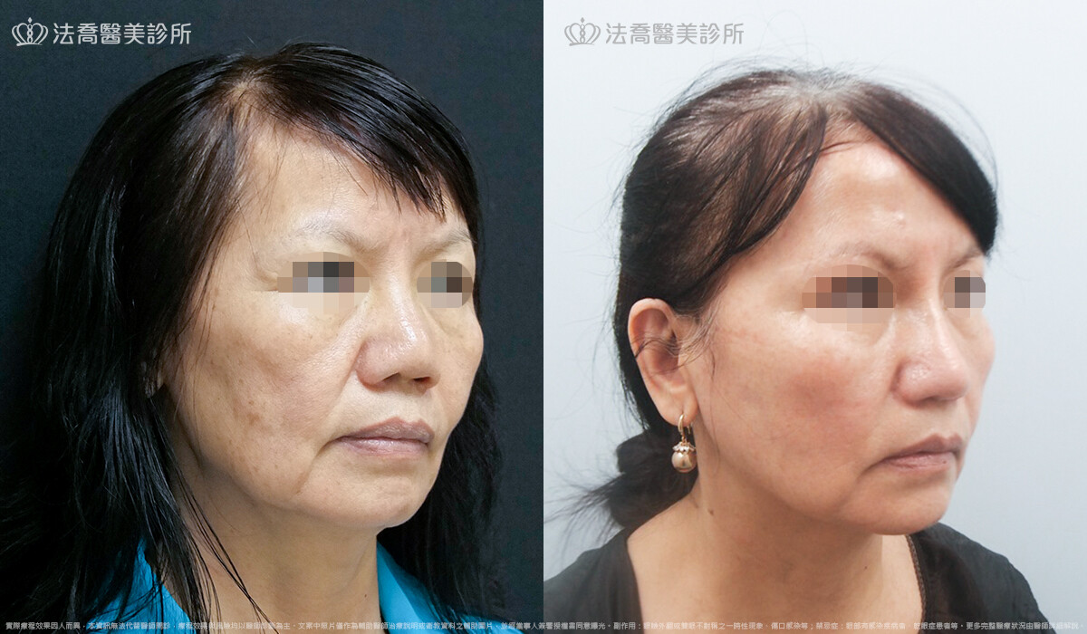 法喬醫美診所,邱浚彥,自體肋骨隆鼻,隆鼻推薦