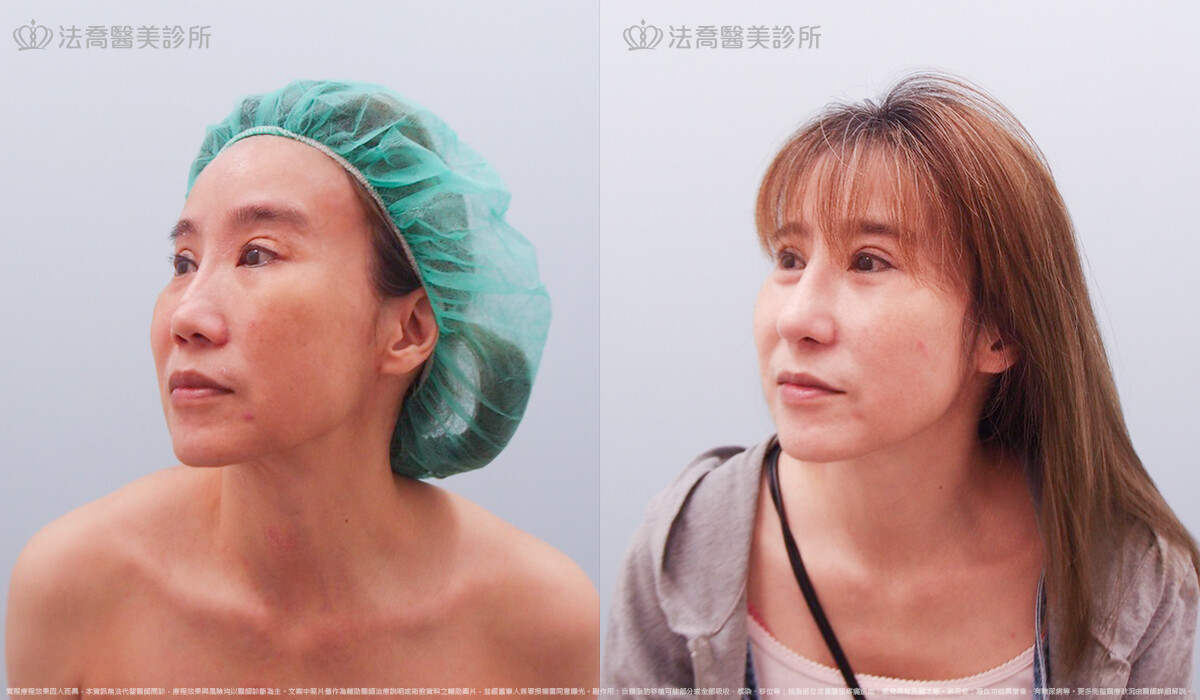 自體肋骨隆鼻,法喬醫美診所,邱浚彥