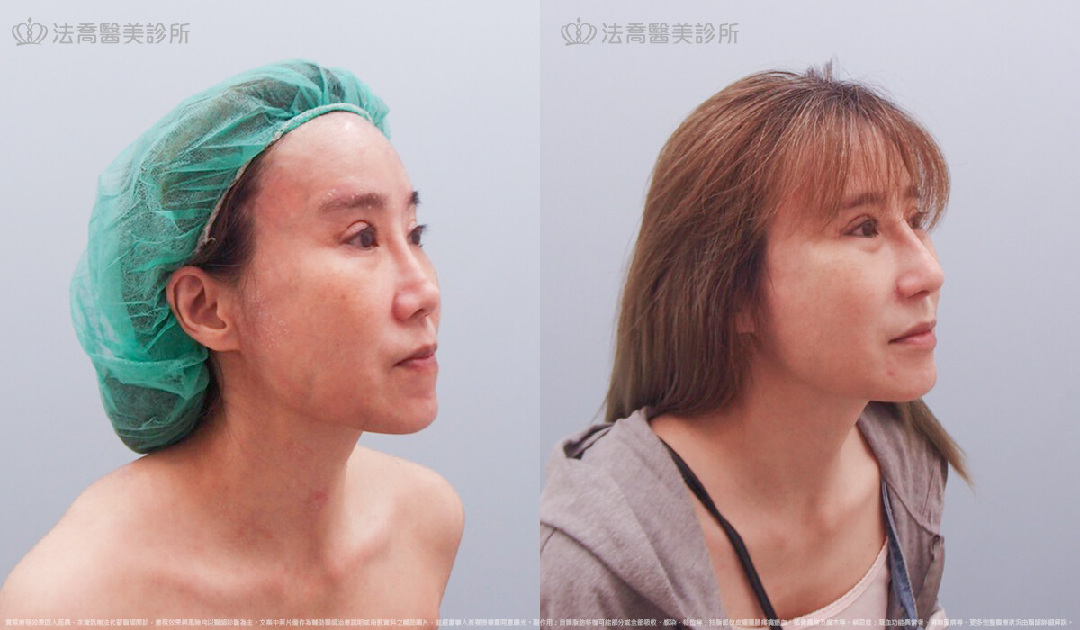 自體肋骨隆鼻,法喬醫美診所,邱浚彥