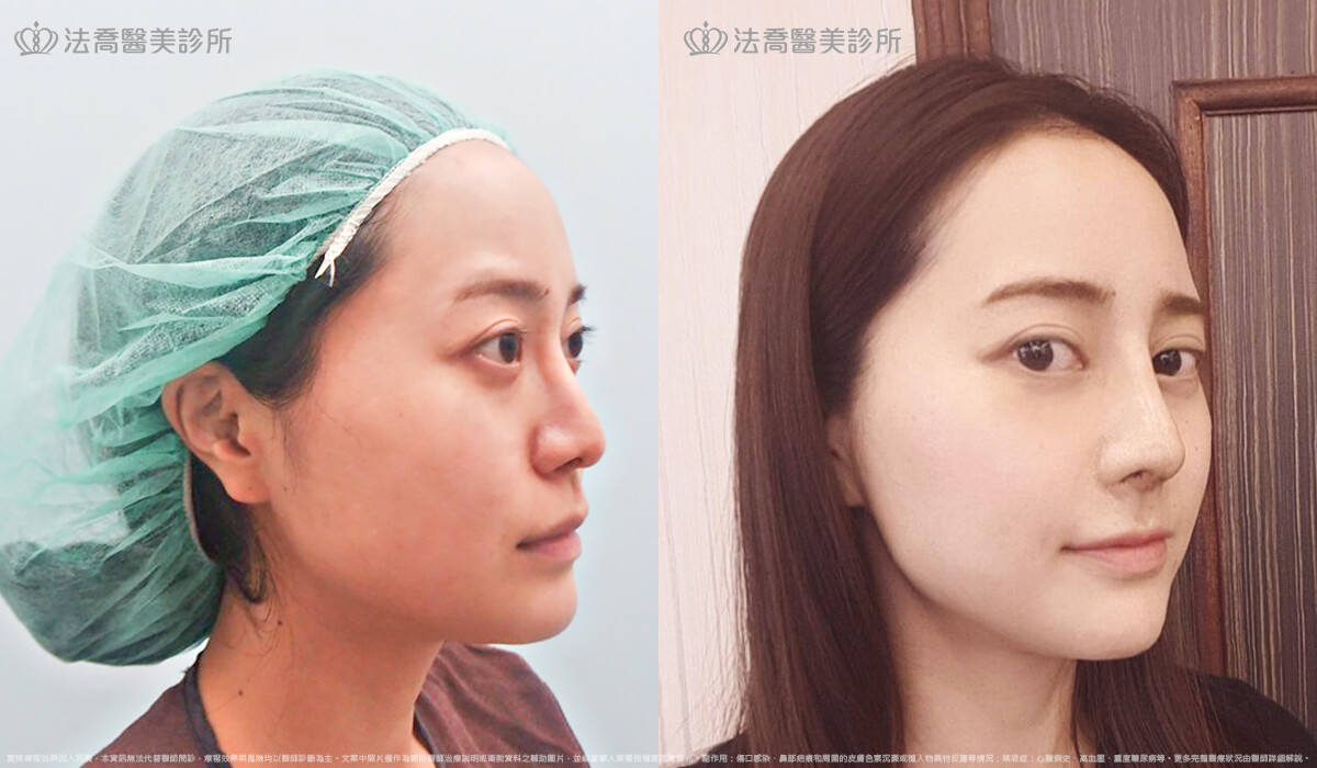 自體肋骨隆鼻,法喬醫美診所,邱浚彥