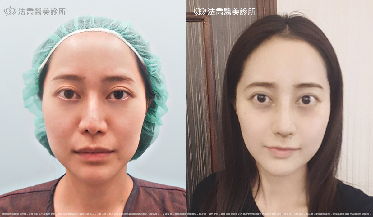 自體肋骨隆鼻,法喬醫美診所,邱浚彥