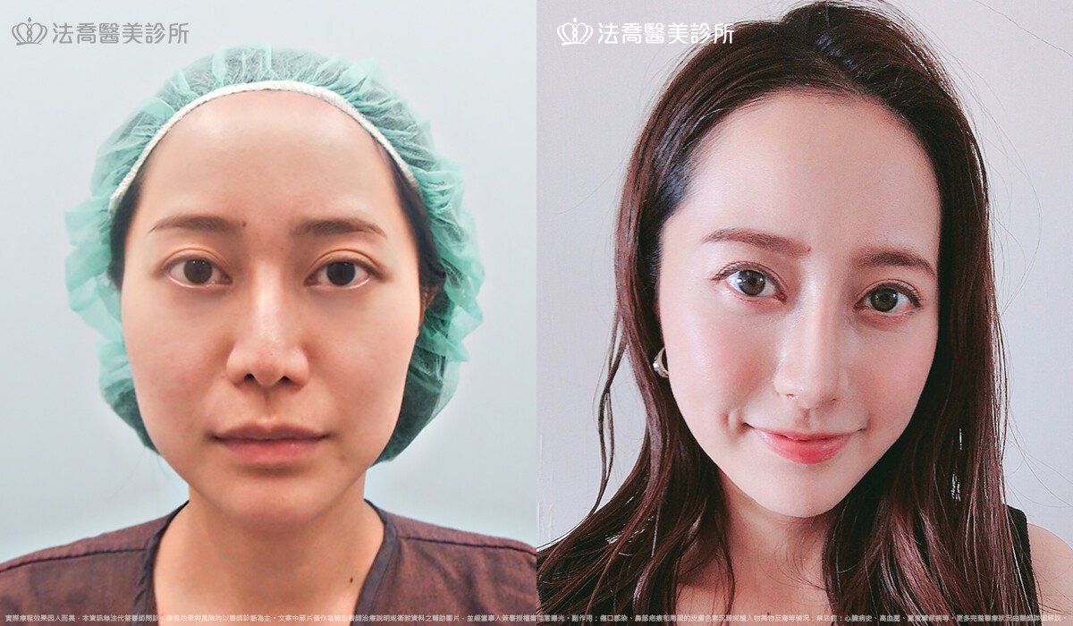 法喬醫美診所,邱浚彥,自體肋骨隆鼻,隆鼻推薦