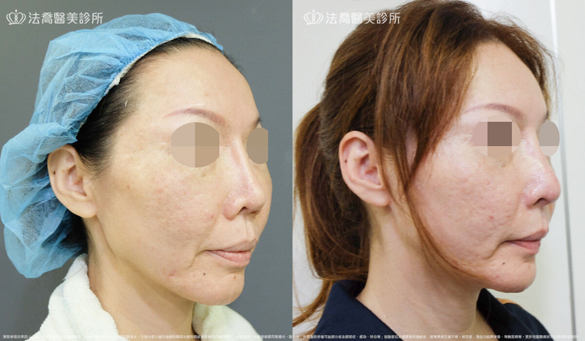 自體肋骨隆鼻,法喬醫美診所,邱浚彥