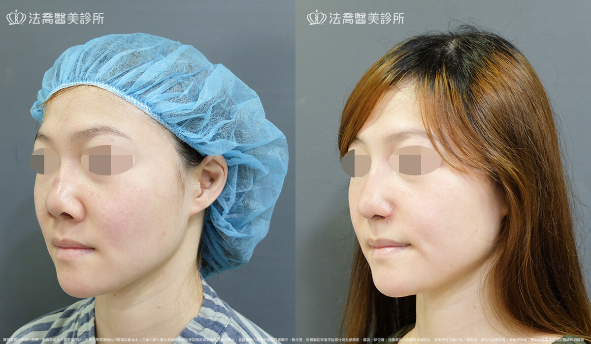 自體肋骨隆鼻,法喬醫美診所,邱浚彥