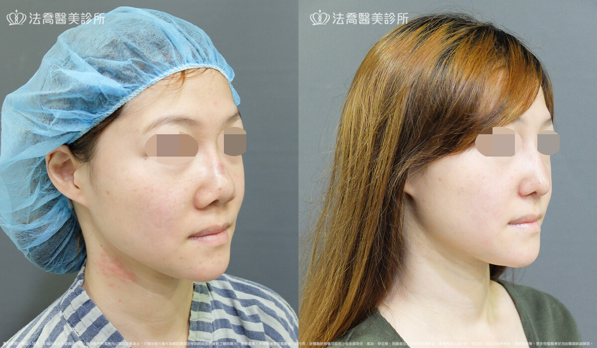 自體肋骨隆鼻,法喬醫美診所,邱浚彥