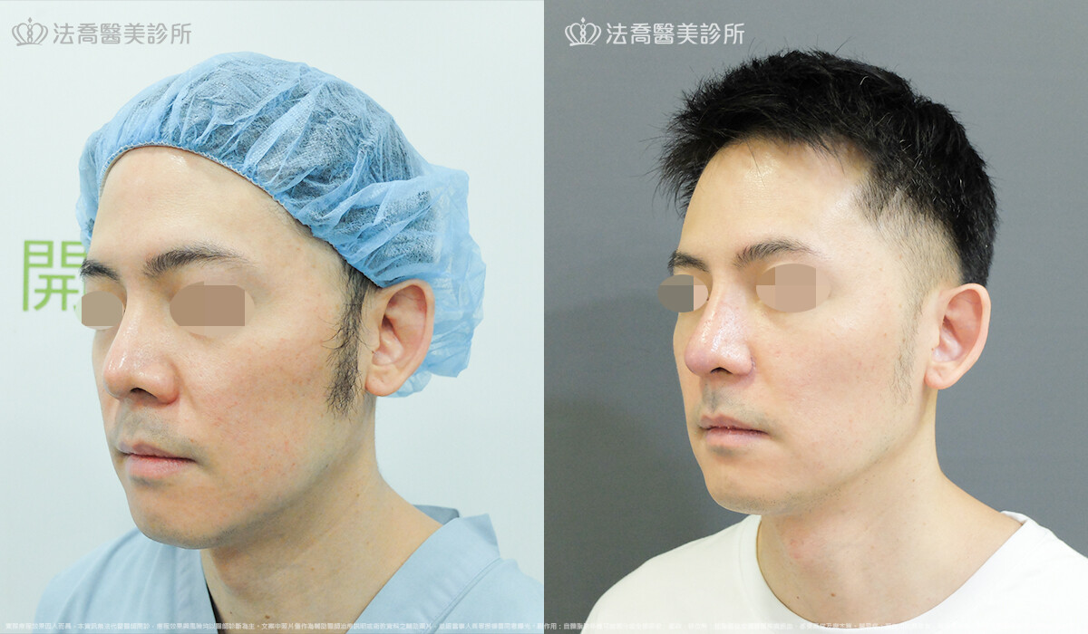 法喬醫美診所,邱浚彥,自體肋骨隆鼻