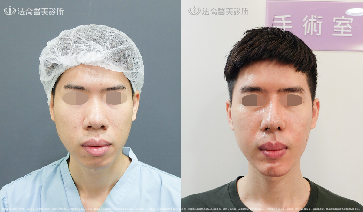 法喬醫美診所,邱浚彥,自體肋骨隆鼻