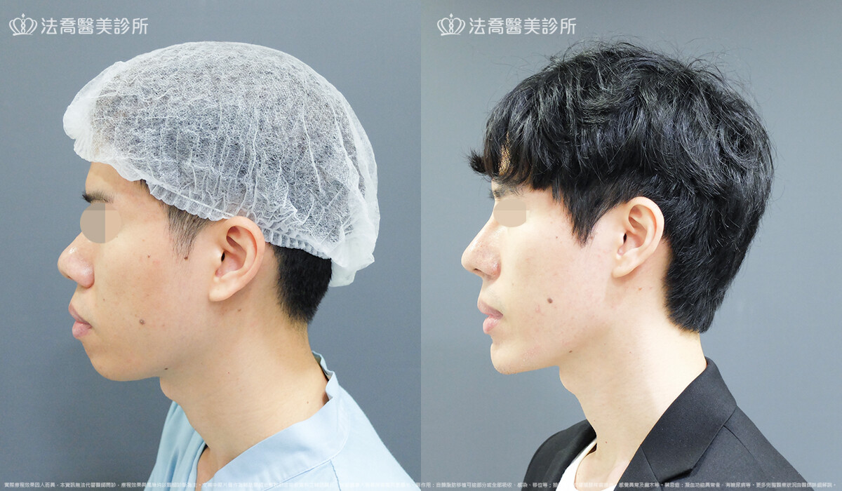 法喬醫美診所,邱浚彥,自體肋骨隆鼻