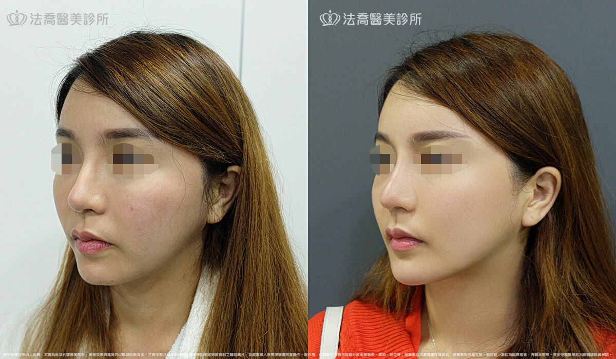 卡麥拉取出 / 自體肋骨隆鼻 / 人工骨墊下巴