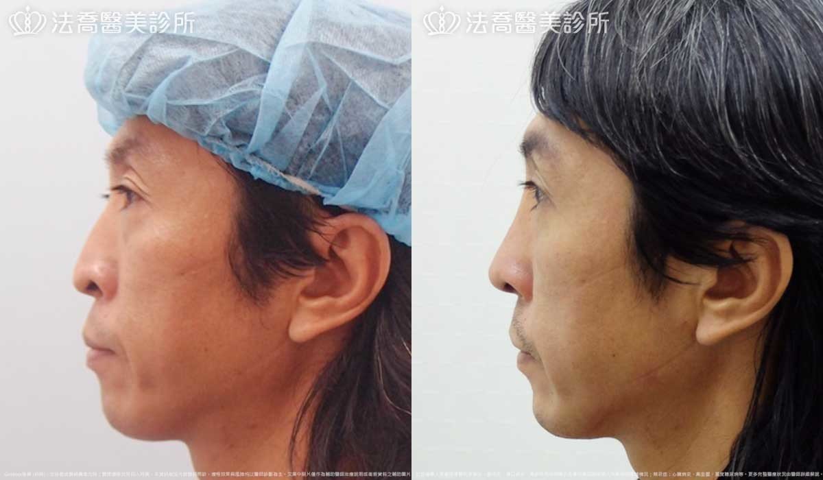 法喬醫美診所,邱浚彥,Goretex隆鼻