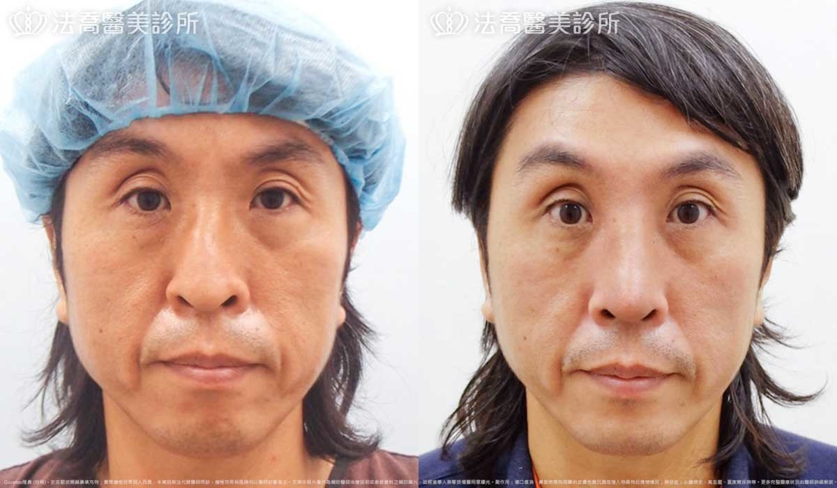 法喬醫美診所,邱浚彥,Goretex隆鼻