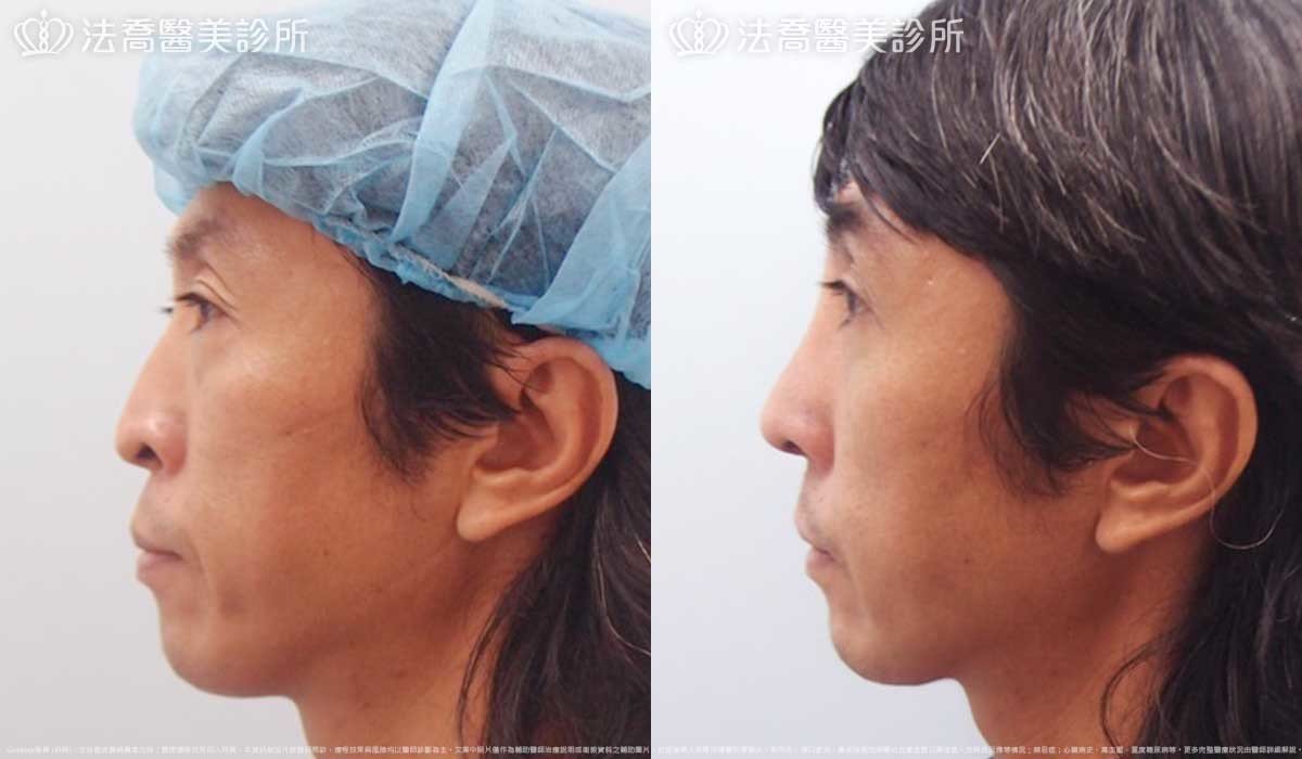 法喬醫美診所,邱浚彥,Goretex隆鼻