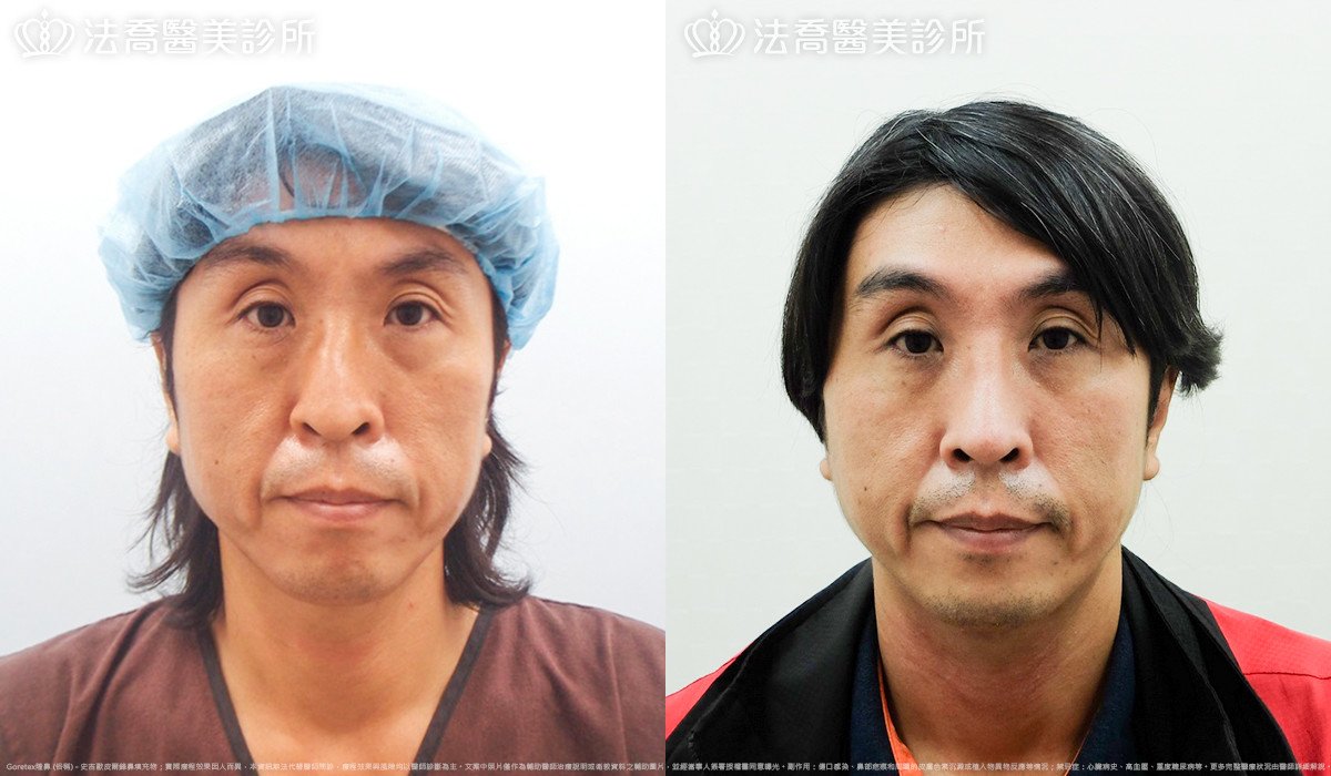 法喬醫美診所,邱浚彥,Goretex隆鼻