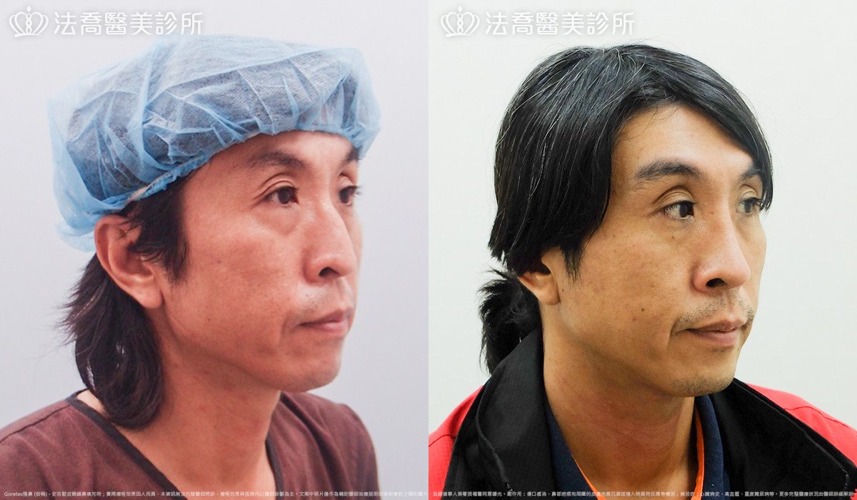 法喬醫美診所,邱浚彥,Goretex隆鼻