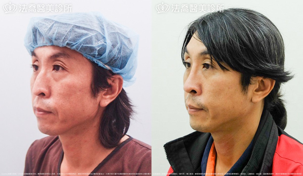 法喬醫美診所,邱浚彥,Goretex隆鼻