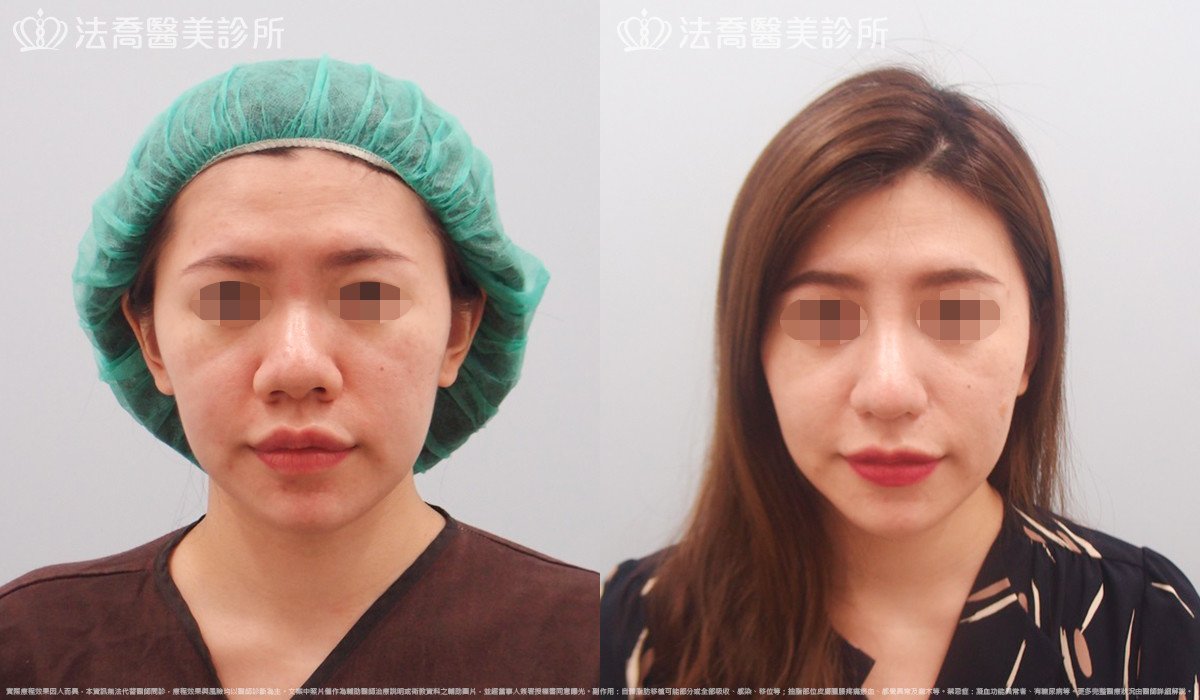 goretex隆鼻,法喬醫美診所,邱浚彥