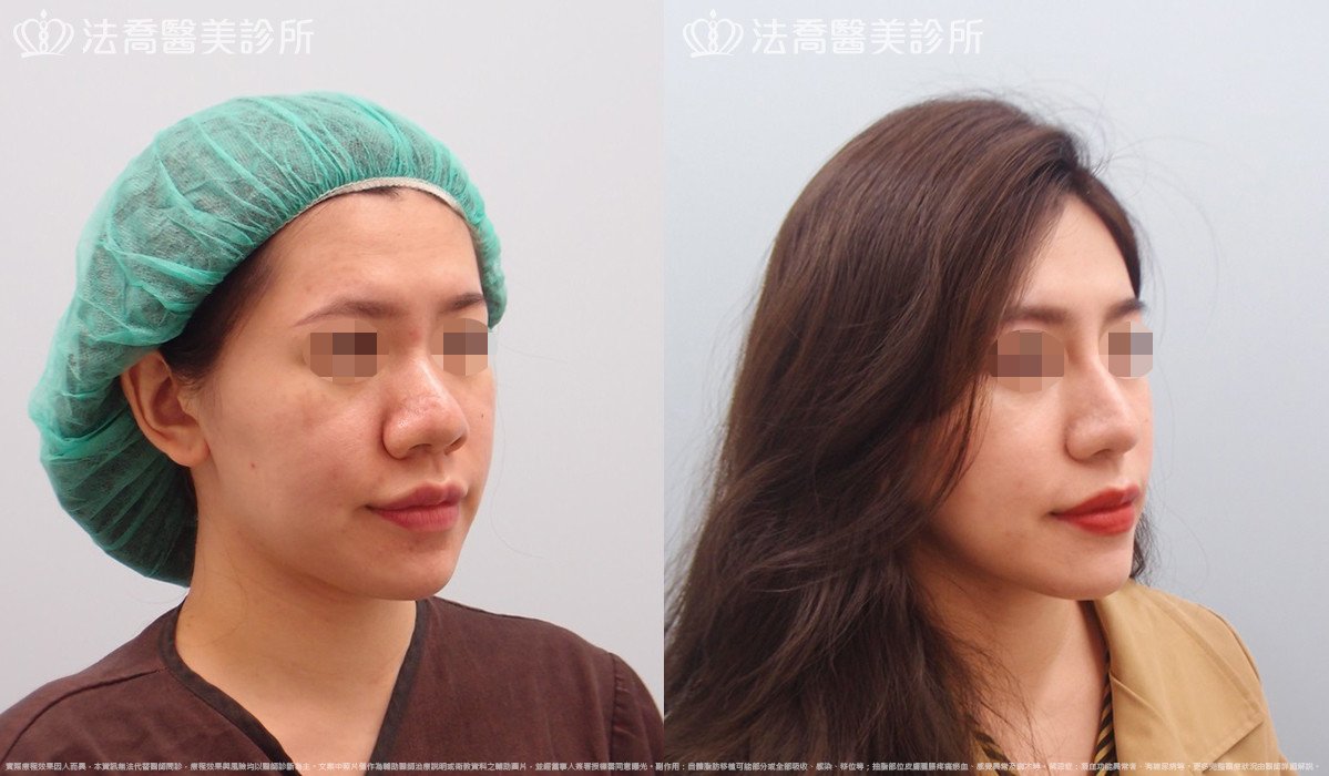 goretex隆鼻,法喬醫美診所,邱浚彥