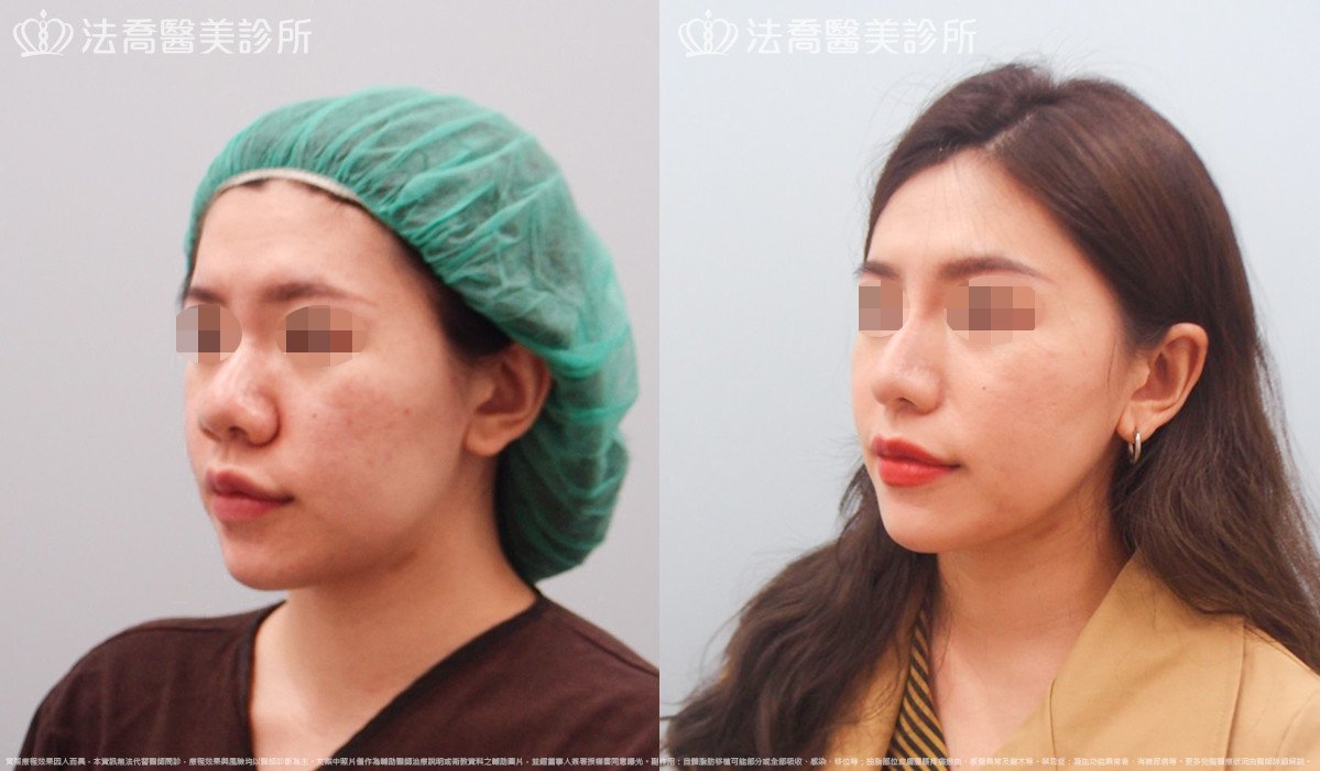 goretex隆鼻,法喬醫美診所,邱浚彥